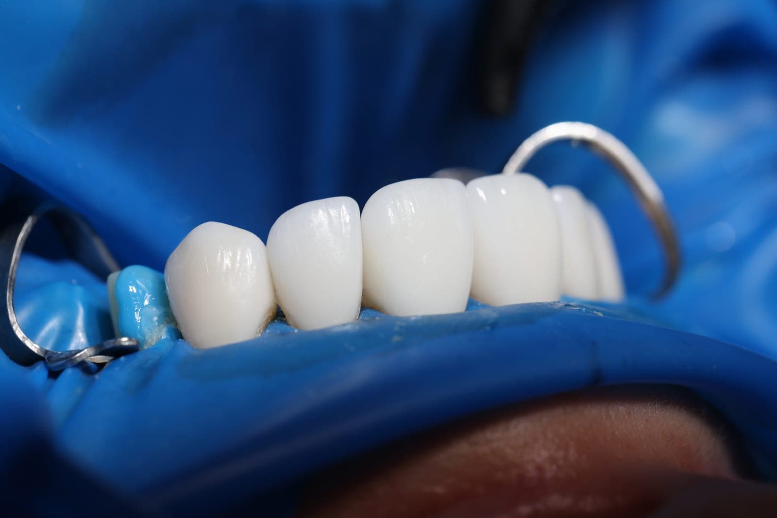 Close-up of careful, gentle restorative dental treatment at Barbican Dental Practice
