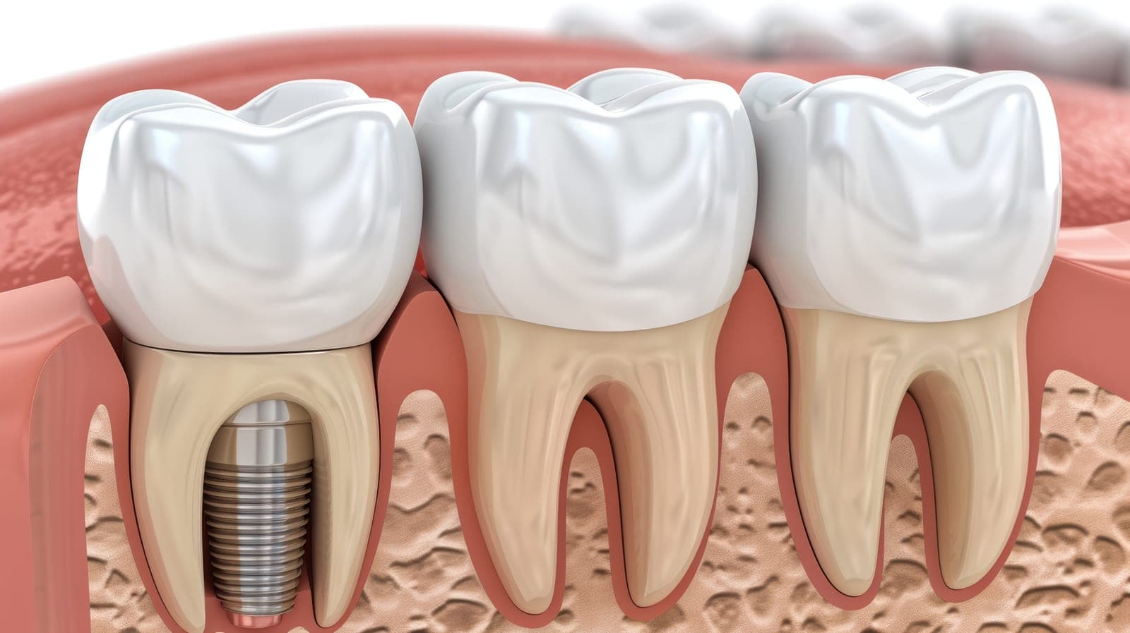 A dental implant model showing how missing teeth can be replaced at Barbican Dental Practice